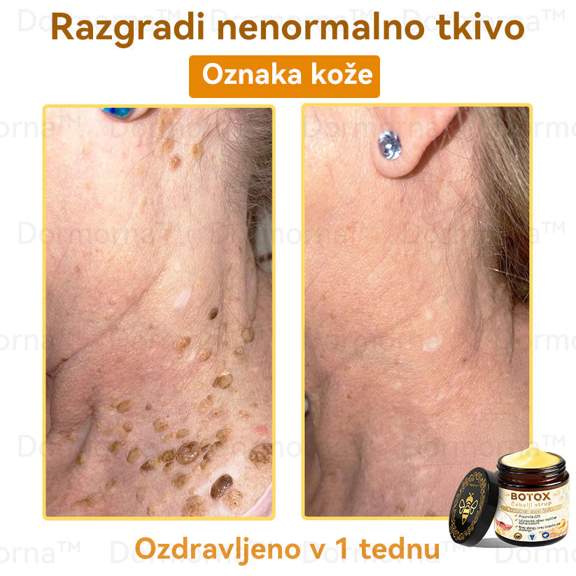 Uradnik klinike Mayo: 🦋𝐒𝐩𝐳𝐯™ 𝐁𝐎𝐓𝐎𝐗 Č𝐞𝐛𝐞𝐥𝐣𝐢 𝐬𝐭𝐫𝐮𝐩 𝐊𝐫𝐞𝐦𝐚 𝐳𝐚 𝐧𝐞𝐠𝐨 𝐤𝐨ž𝐞, Vlaženje, popravilo kože, enakomeren ten, zdravljenje aken in temnih madežev, odstranjevanje bradavic in madežev, lajšanje luskavice