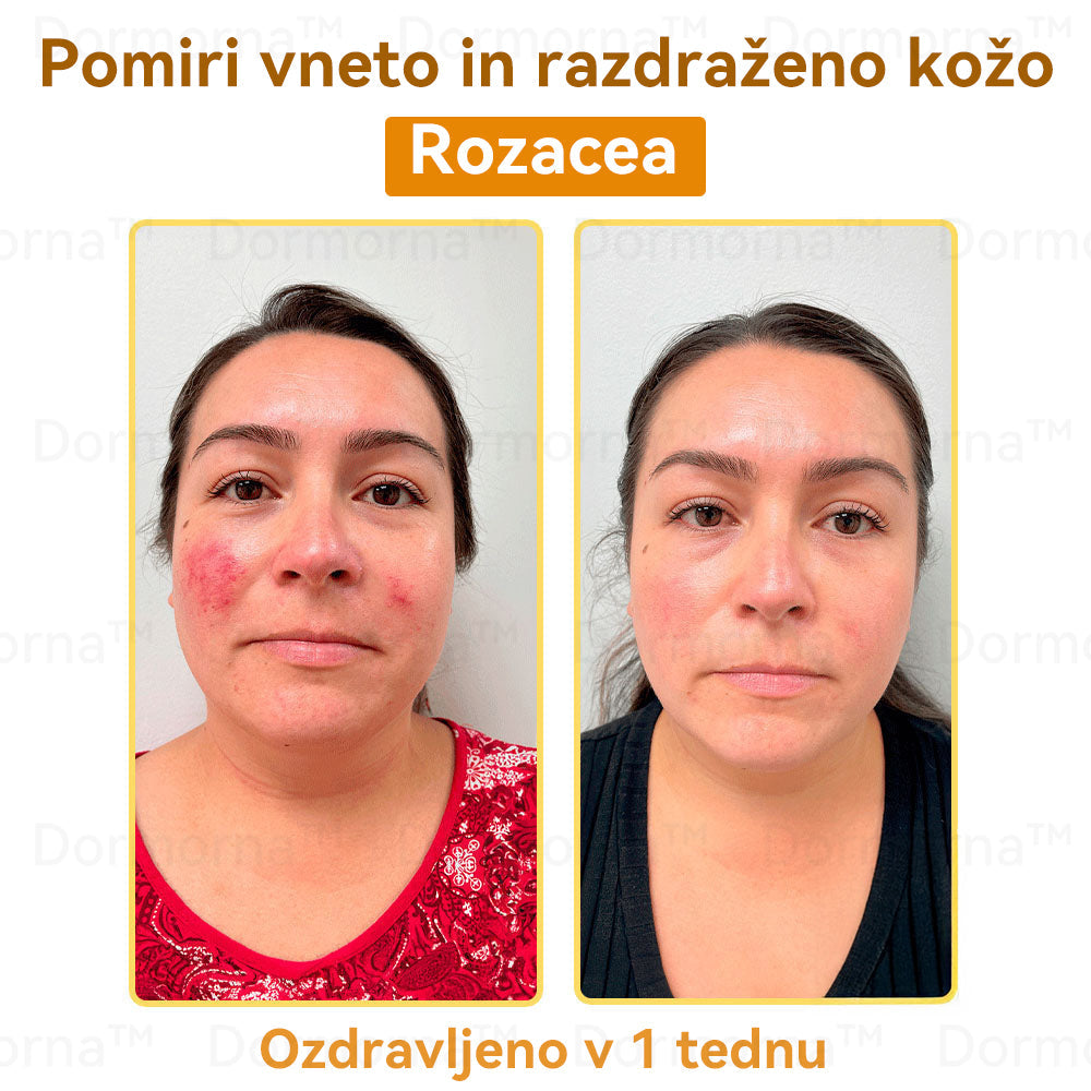Uradnik klinike Mayo: 🦋𝐒𝐩𝐳𝐯™ 𝐁𝐎𝐓𝐎𝐗 Č𝐞𝐛𝐞𝐥𝐣𝐢 𝐬𝐭𝐫𝐮𝐩 𝐊𝐫𝐞𝐦𝐚 𝐳𝐚 𝐧𝐞𝐠𝐨 𝐤𝐨ž𝐞, Vlaženje, popravilo kože, enakomeren ten, zdravljenje aken in temnih madežev, odstranjevanje bradavic in madežev, lajšanje luskavice